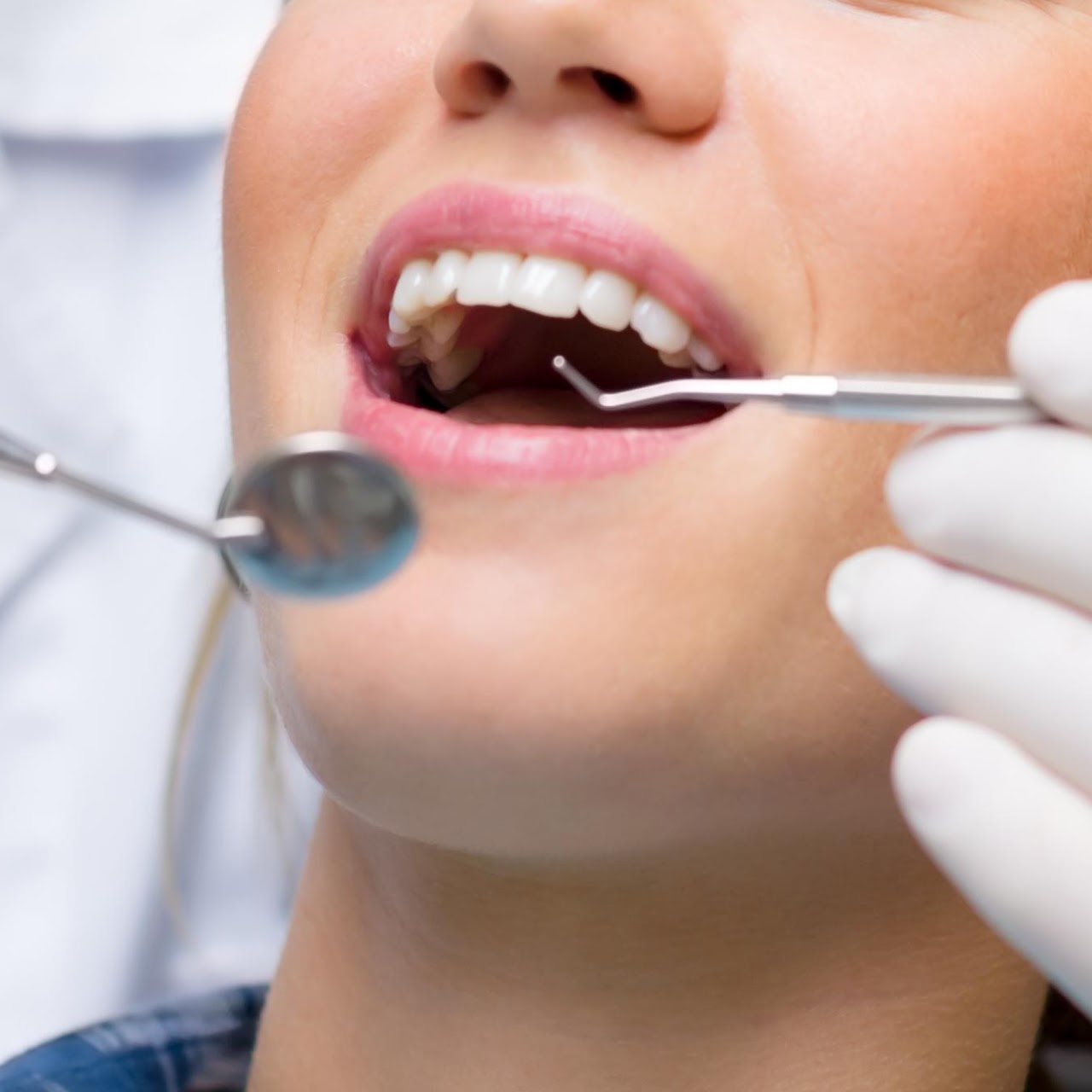 Detartrasi e Igiene Dentale Professionale