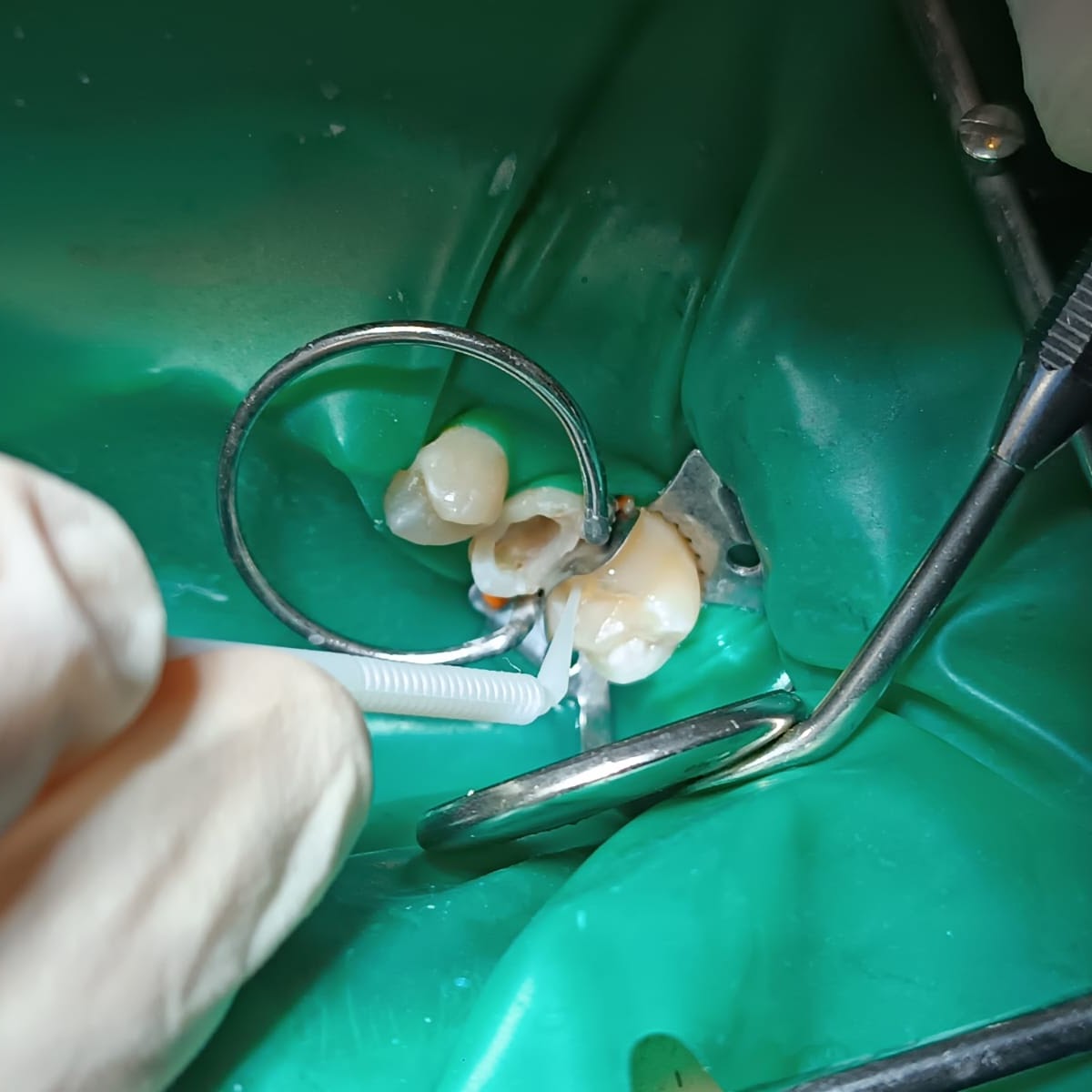 Trattamenti di Endodonzia