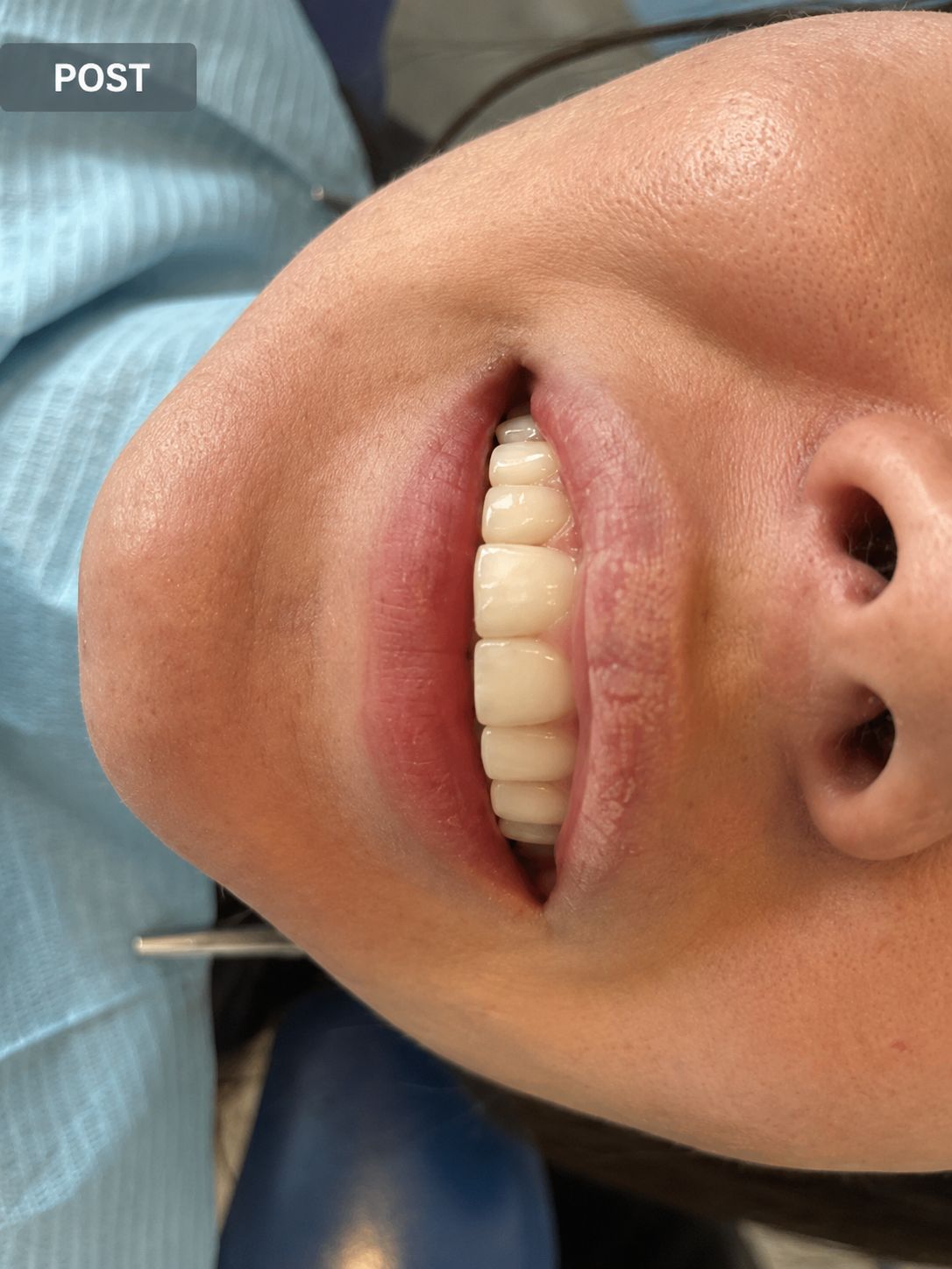 Sorriso con faccette estetiche, dopo il trattamento