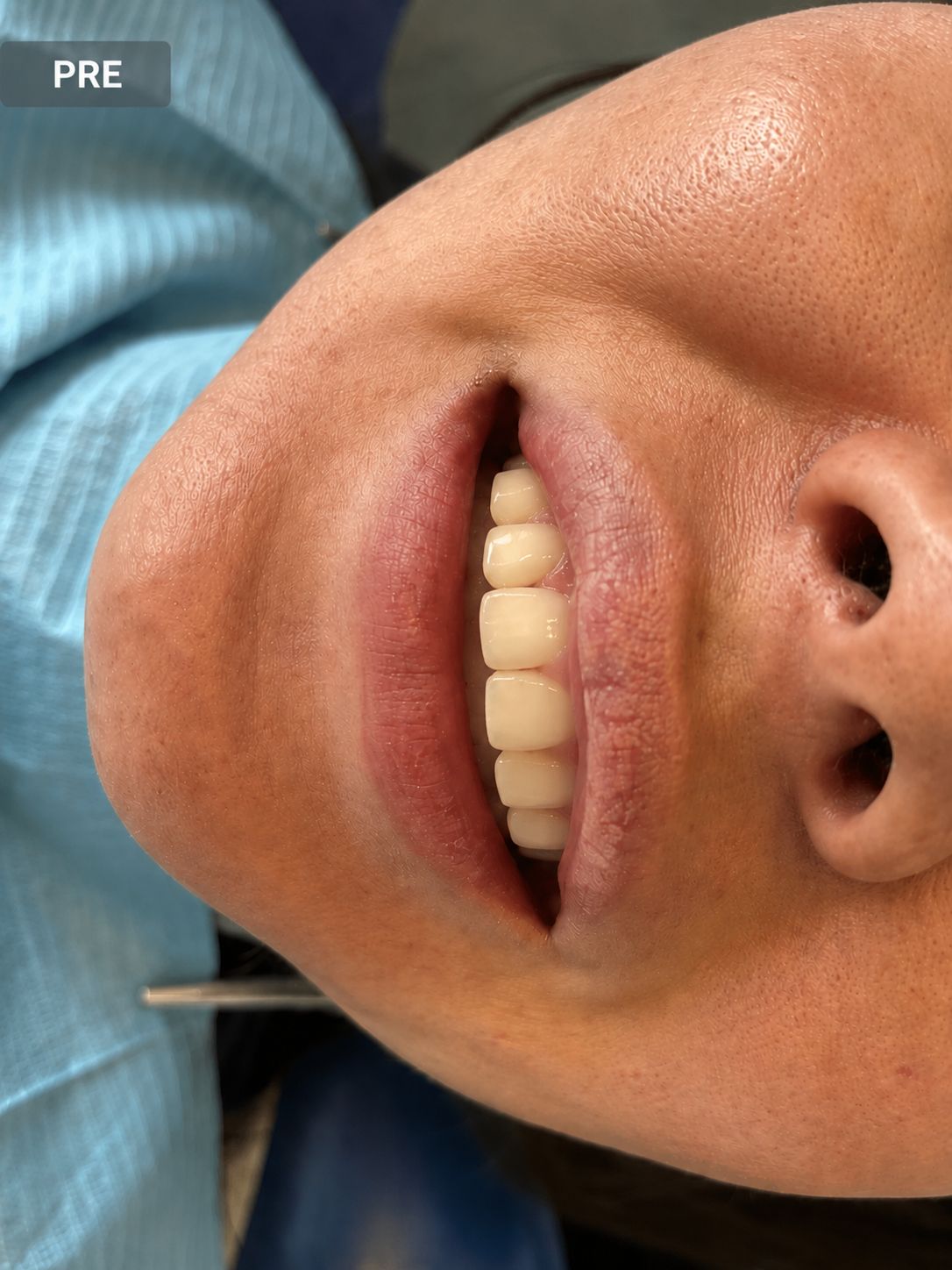 Denti prima dell'applicazione delle faccette estetiche