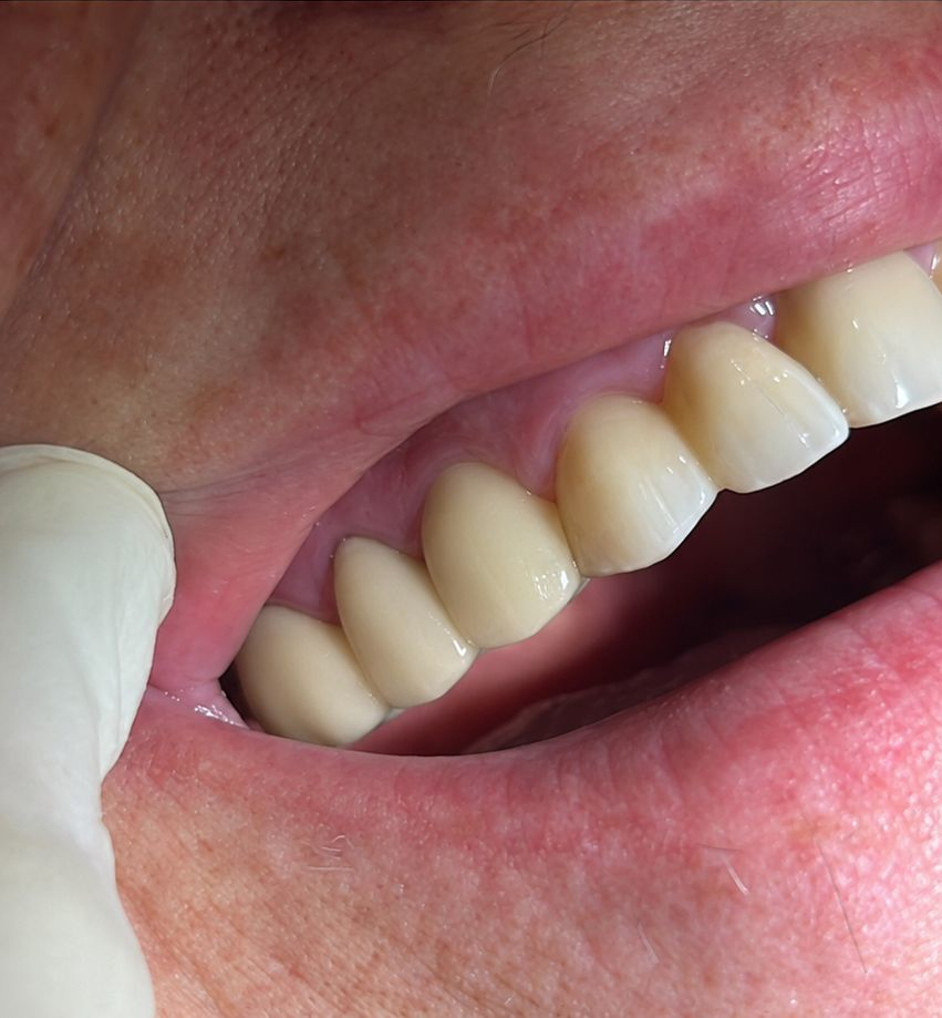 Sorriso con impianto a carico immediato, dopo il trattamento