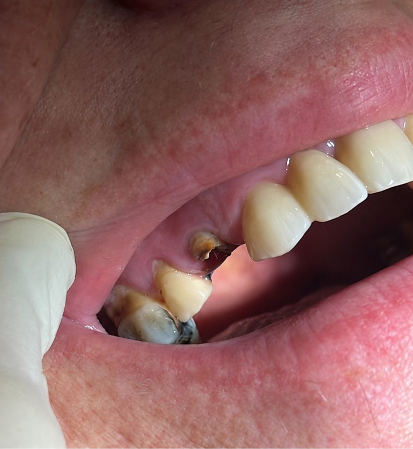 Arcata con dente mancante, prima dell'impianto