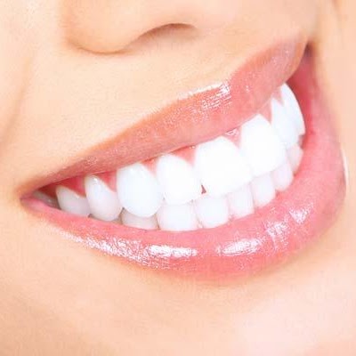 Sbiancamento Dentale Professionale